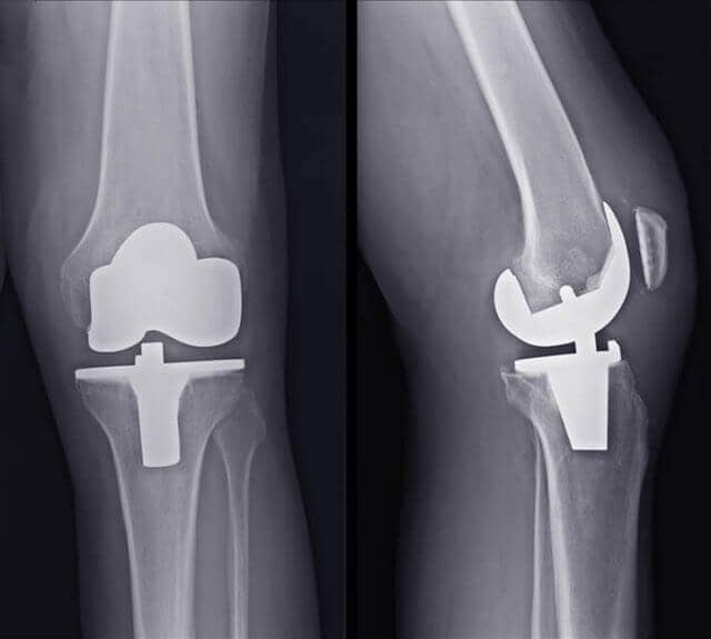 Η ολική αρθροπλαστική του γόνατος (αλλαγή γόνατος) είναι η αντικατάσταση των επιφανειών των οστών της άρθρωσης που έρχονται σε επαφή και είναι φθαρμένες