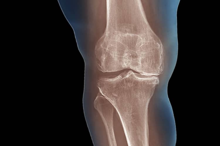Εικόνα: Οστεοαρθρίτιδα γόνατος - Οδηγίες από τον ορθοπεδικό Βασιλόπουλο Αριστομένη