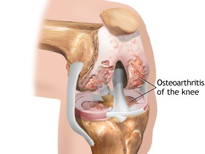 Η οστεοαρθρίτιδα γόνατος αρχικά συνήθως εκδηλώνεται σε ένα από τα διαμερίσματα του γόνατος (το έσω, το έξω και την επιγονατιδομηριαία άρθρωση